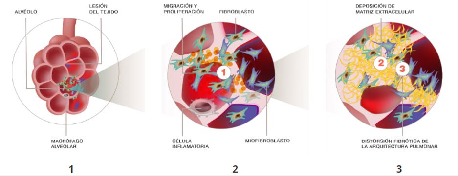 Cúmulo de células inflamatorias en los pulmones